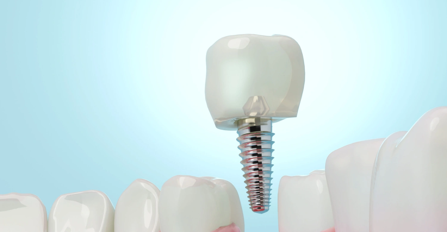 Single Tooth Implant Inblog